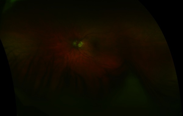 Optomap Left Eye