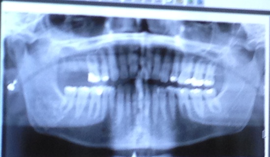 My Teeth Xray